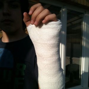 Orthopedic_cast_Vincent's_Gips_Arm