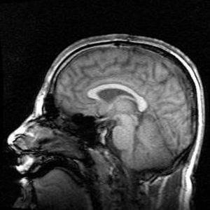 600px-Mri_brain_side_view